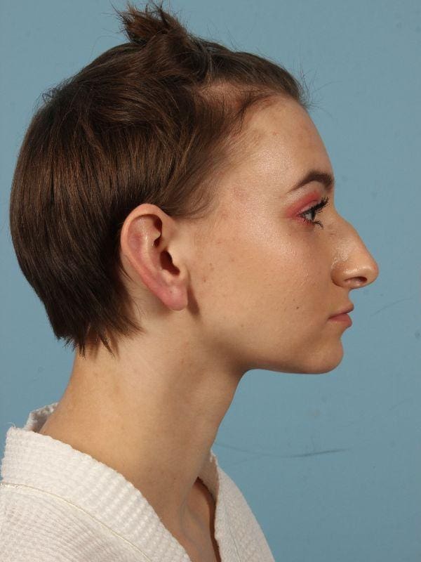 Rhinoplasty Patient Photo - Case 16513 - before view-2