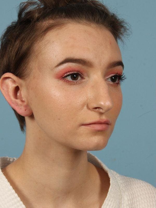 Rhinoplasty Patient Photo - Case 16513 - before view-4