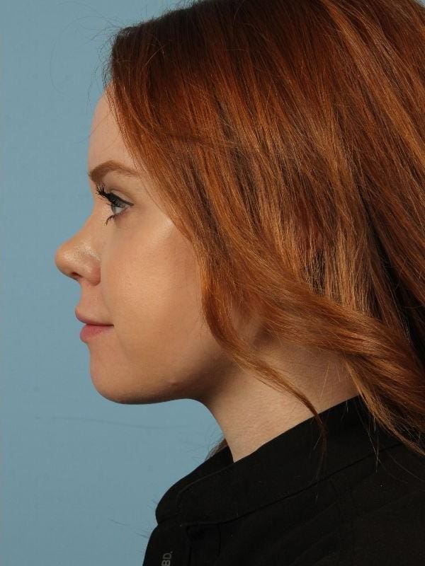 Rhinoplasty Patient Photo - Case 16526 - after view-1