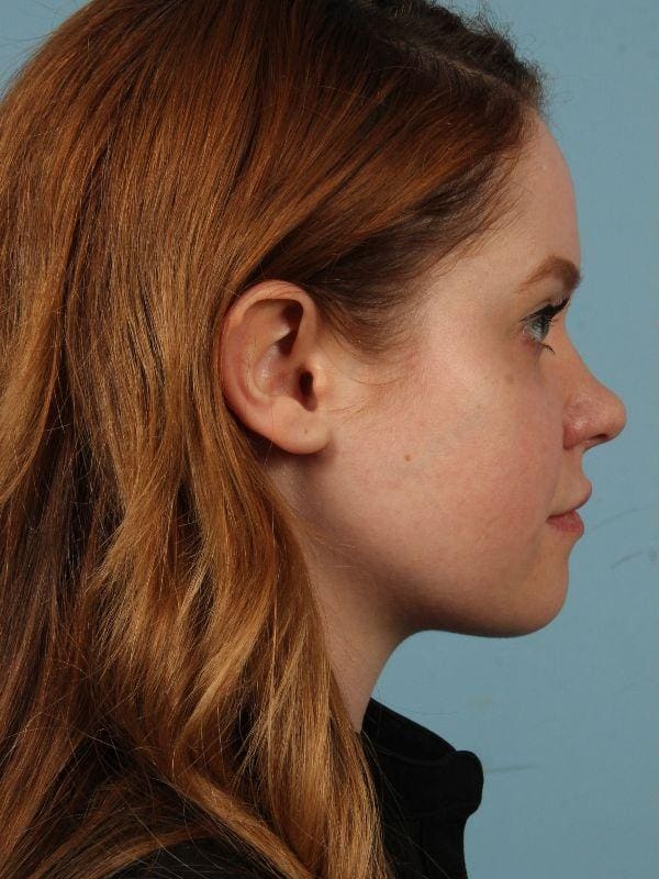 Rhinoplasty Patient Photo - Case 16526 - before view-2