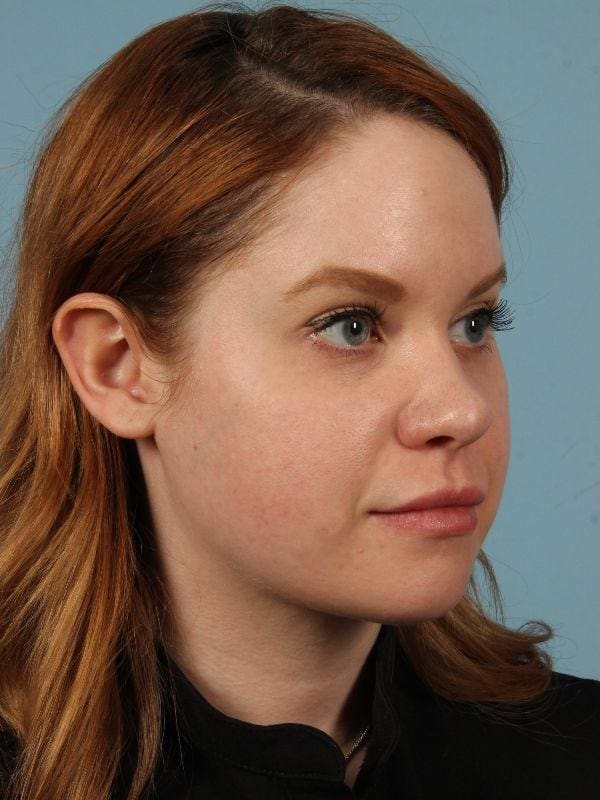 Rhinoplasty Patient Photo - Case 16526 - before view-4