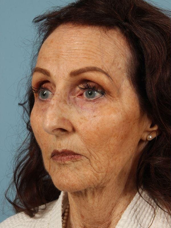 Rhinoplasty Patient Photo - Case 16539 - before view-3
