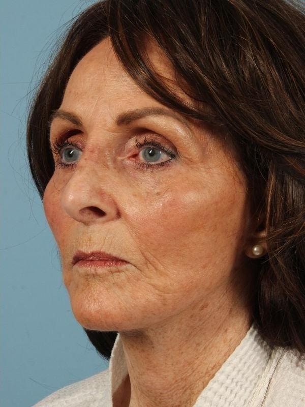 Rhinoplasty Patient Photo - Case 16539 - after view-3