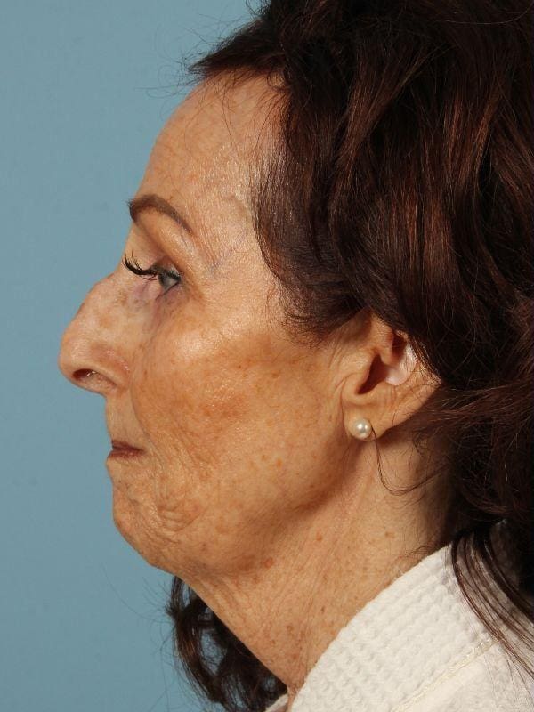 Rhinoplasty Patient Photo - Case 16539 - before view-1