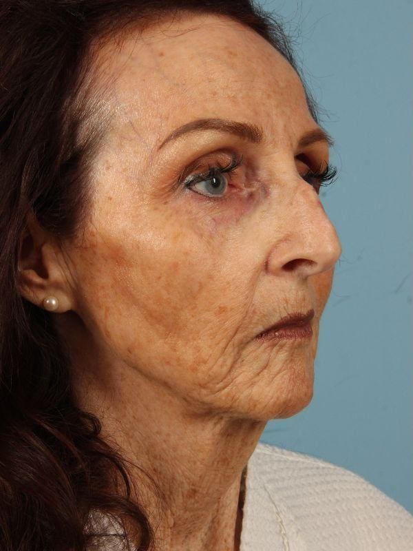 Rhinoplasty Patient Photo - Case 16539 - before view-4