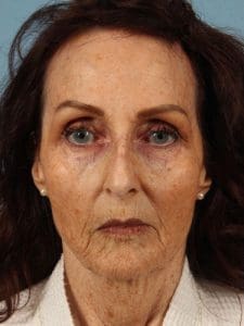 Rhinoplasty - Case 16539 - Before