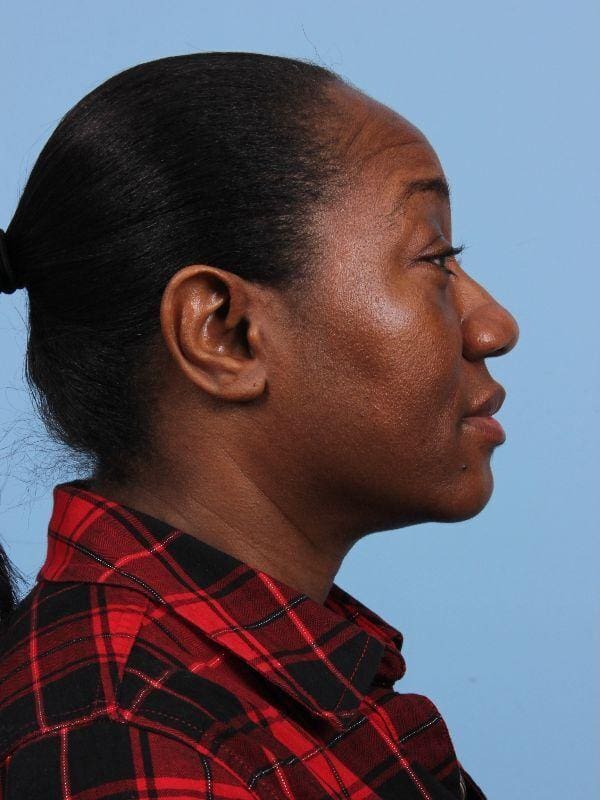Rhinoplasty Patient Photo - Case 16551 - before view-2