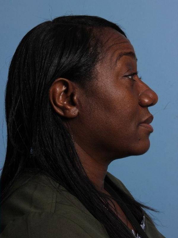 Rhinoplasty Patient Photo - Case 16551 - after view-2