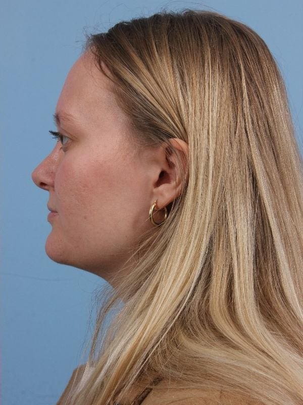 Rhinoplasty Patient Photo - Case 16563 - after view-1