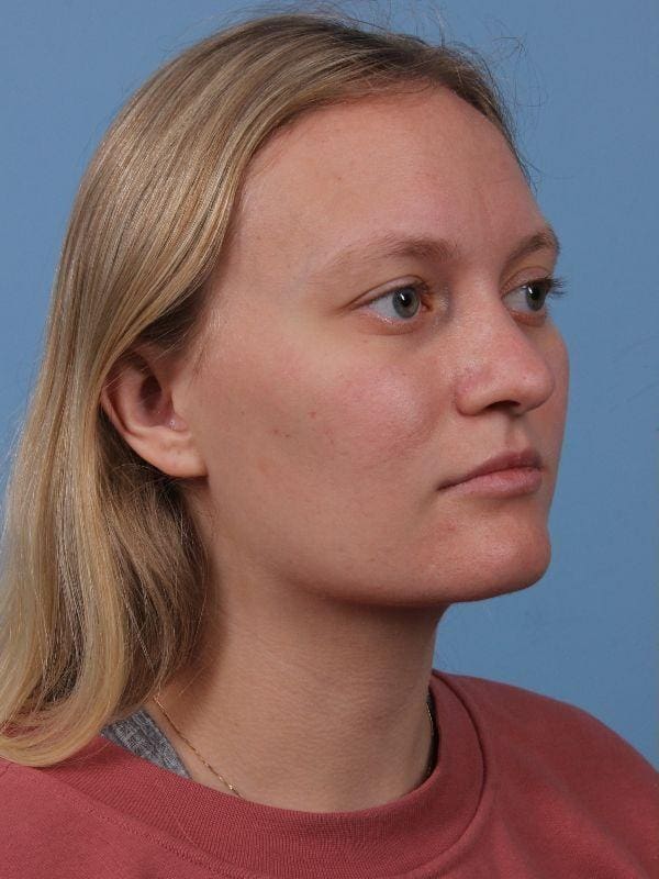 Rhinoplasty Patient Photo - Case 16563 - before view-4