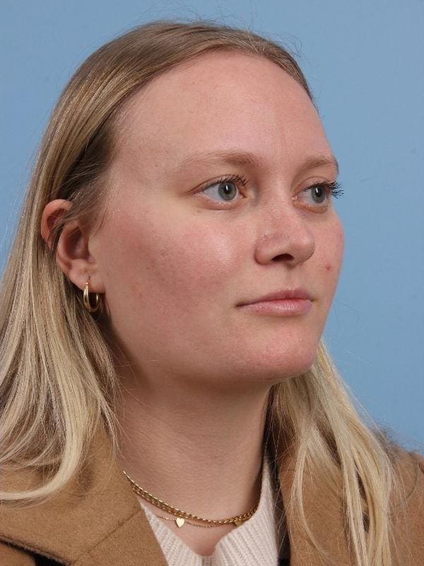 Rhinoplasty Patient Photo - Case 16563 - after view-4