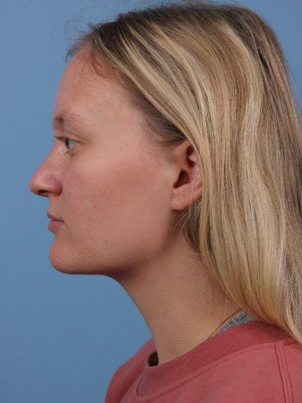 Rhinoplasty Patient Photo - Case 16563 - before view-1