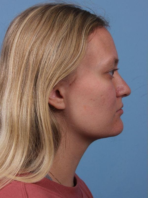 Rhinoplasty Patient Photo - Case 16563 - before view-2