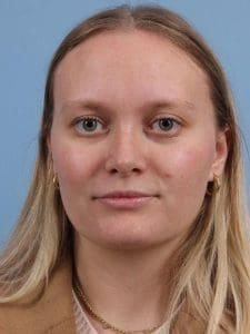 Rhinoplasty - Case 16563 - After