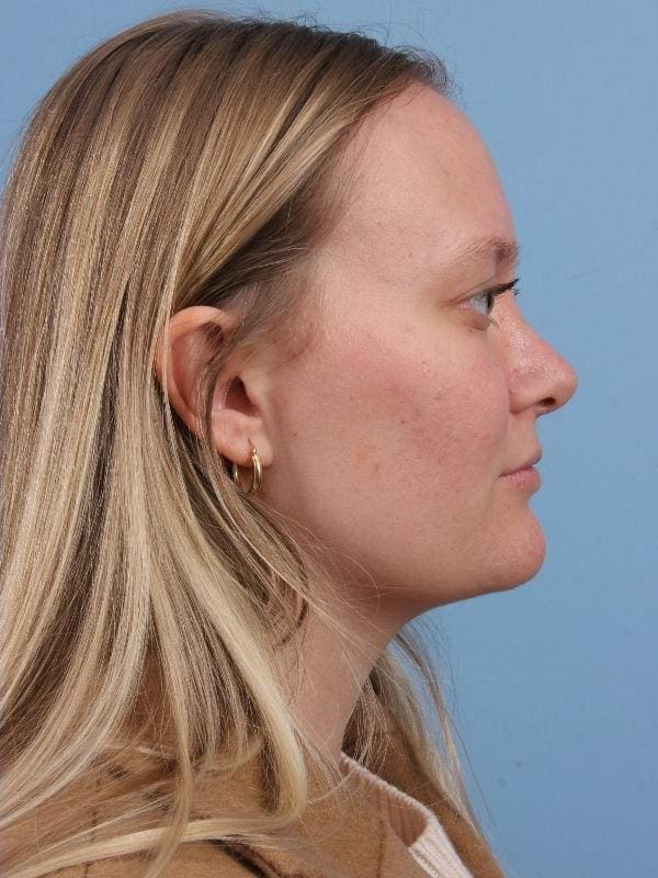 Rhinoplasty Patient Photo - Case 16563 - after view-2