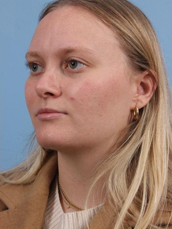 Rhinoplasty Patient Photo - Case 16563 - after view-3