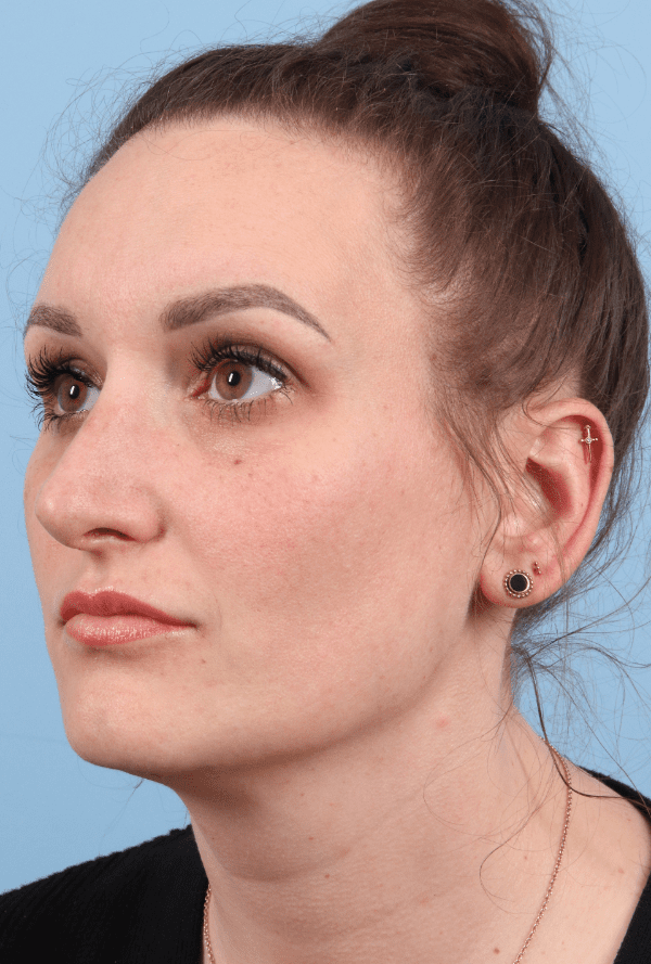 Rhinoplasty Patient Photo - Case 16576 - after view-3