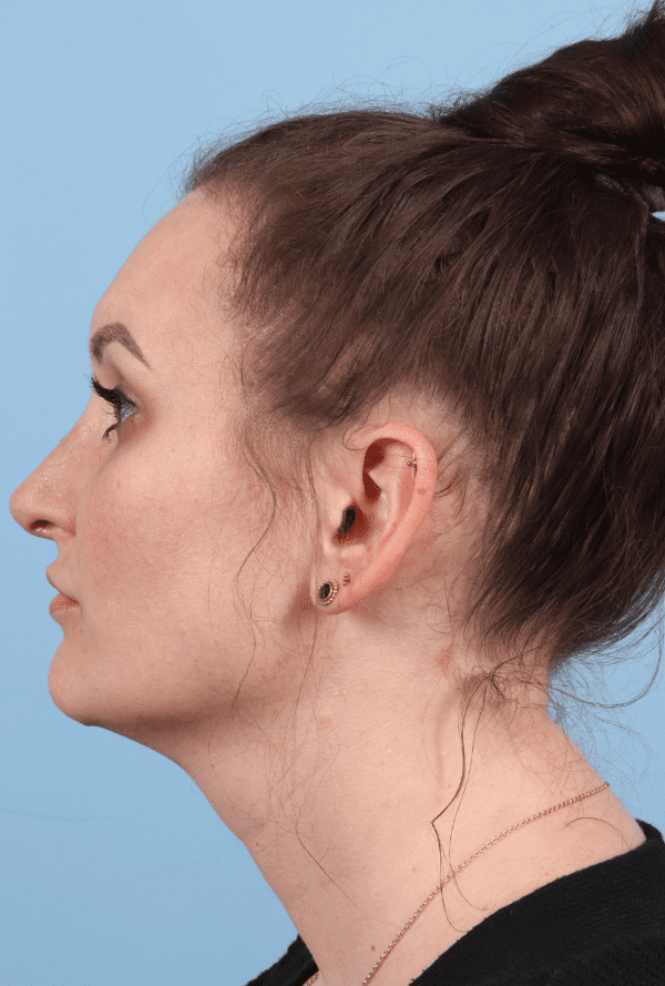 Rhinoplasty Patient Photo - Case 16576 - after view-1