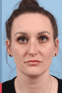 Rhinoplasty - Case 16576 - After