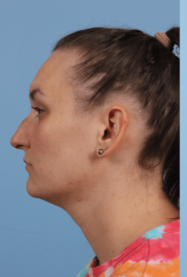 Rhinoplasty Patient Photo - Case 16576 - before view-1