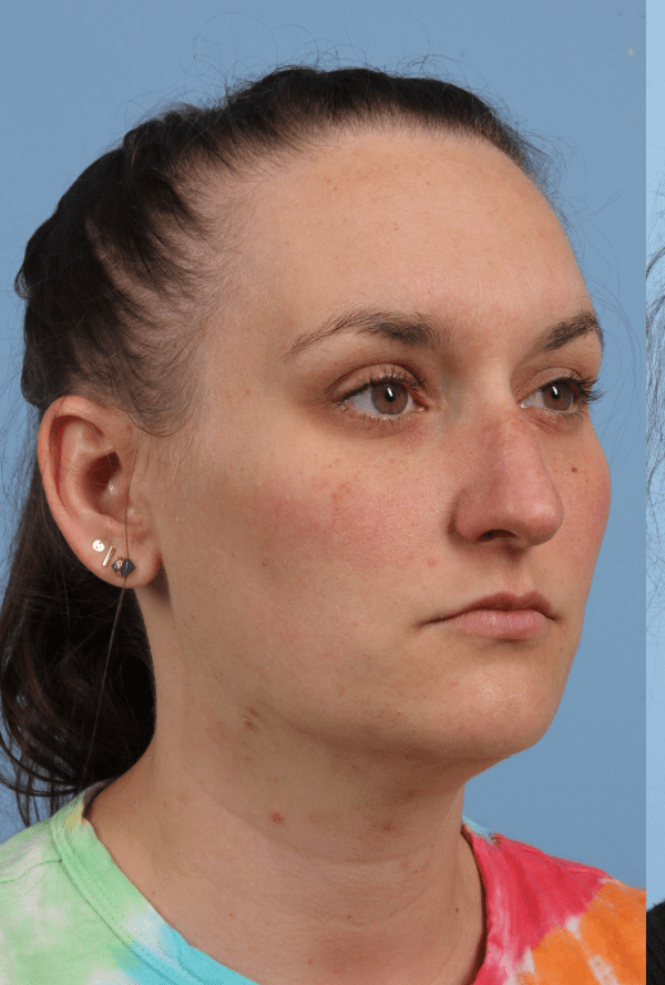 Rhinoplasty Patient Photo - Case 16576 - before view-4