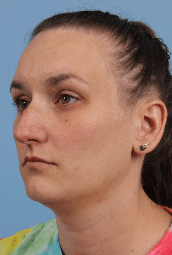 Rhinoplasty Patient Photo - Case 16576 - before view-3