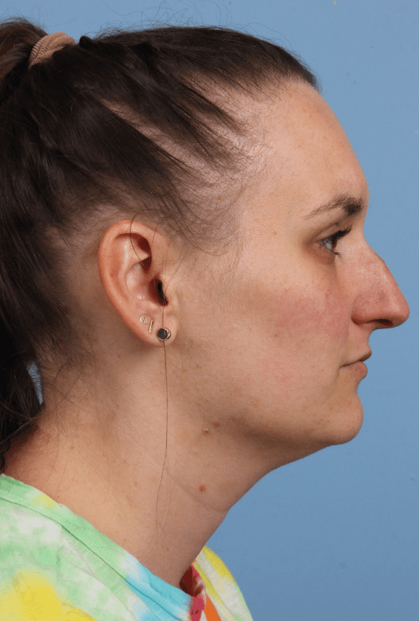Rhinoplasty Patient Photo - Case 16576 - before view-2