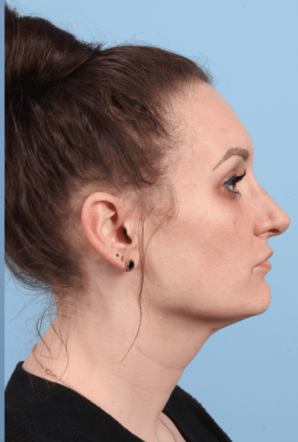Rhinoplasty Patient Photo - Case 16576 - after view-2
