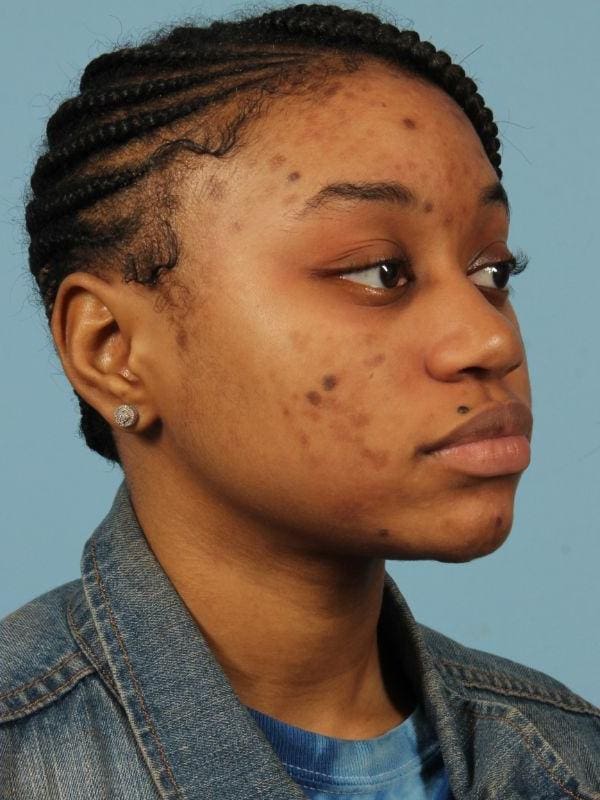 Skin Resurfacing Patient Photo - Case 16589 - after view-1