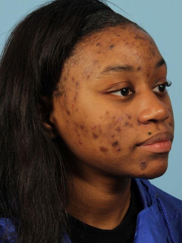 Skin Resurfacing Patient Photo - Case 16589 - before view-1