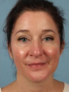 Skin Resurfacing - Case 16595 - After