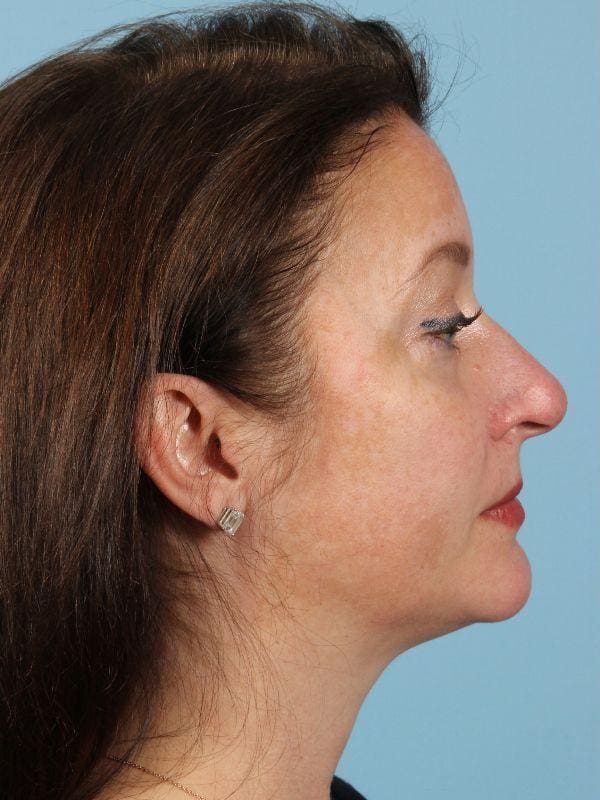 Skin Resurfacing Patient Photo - Case 16595 - before view-1