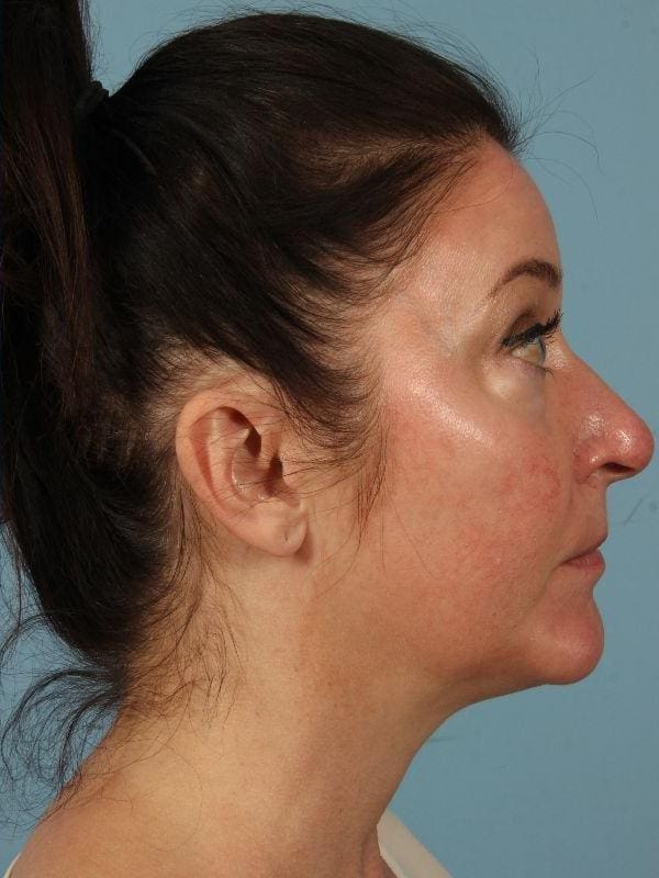 Skin Resurfacing Patient Photo - Case 16595 - after view-1