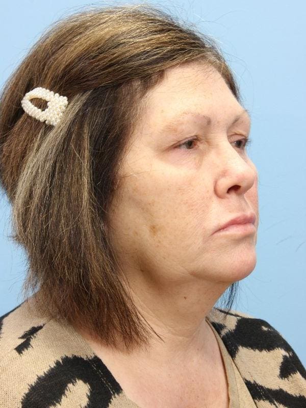 Skin Resurfacing Patient Photo - Case 16602 - after view-4