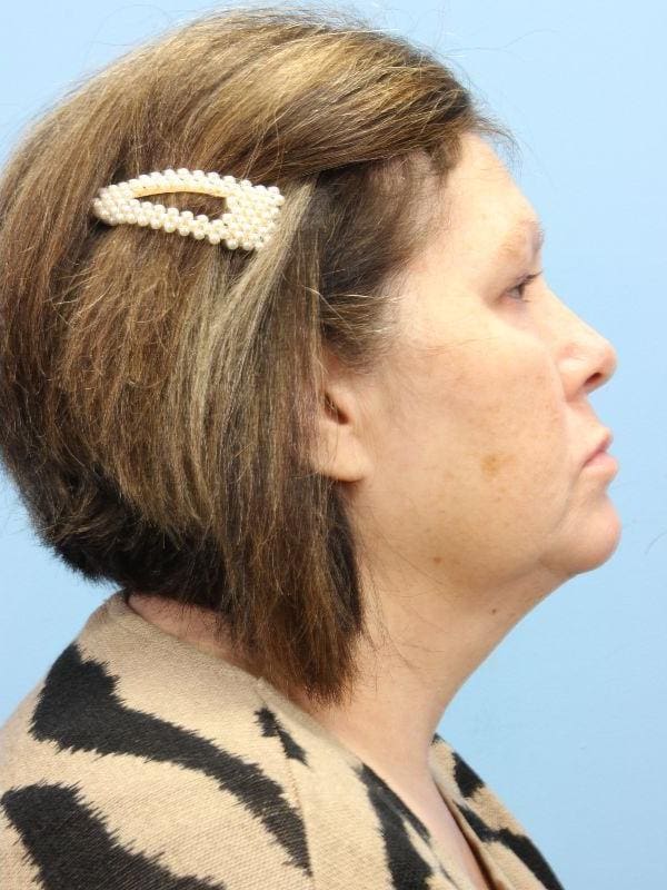 Skin Resurfacing Patient Photo - Case 16602 - after view-2