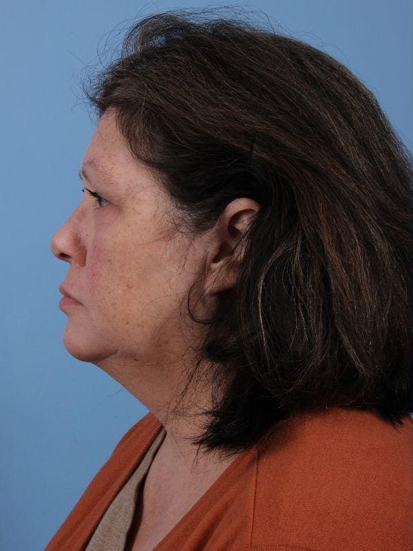 Skin Resurfacing Patient Photo - Case 16602 - before view-1