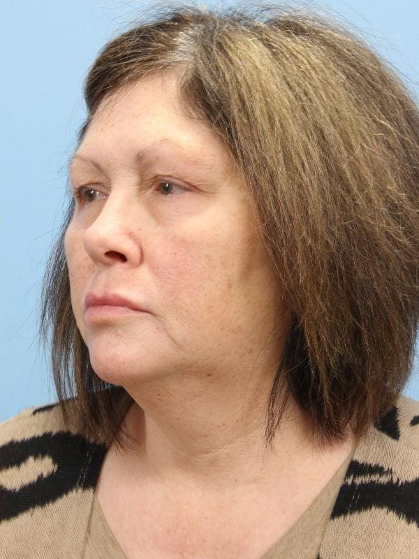 Skin Resurfacing Patient Photo - Case 16602 - after view-3