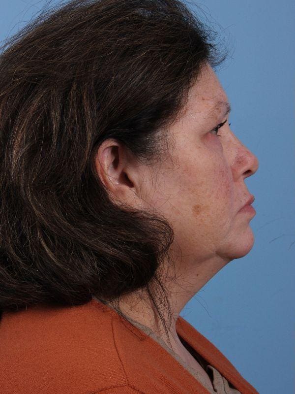 Skin Resurfacing Patient Photo - Case 16602 - before view-2