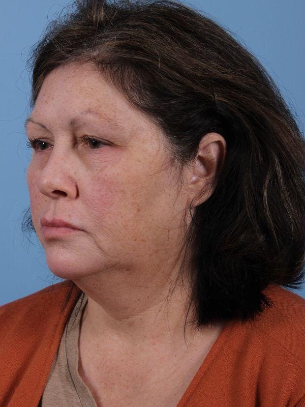 Skin Resurfacing Patient Photo - Case 16602 - before view-3
