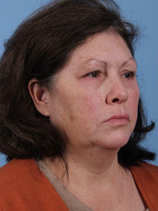 Skin Resurfacing Patient Photo - Case 16602 - before view-4