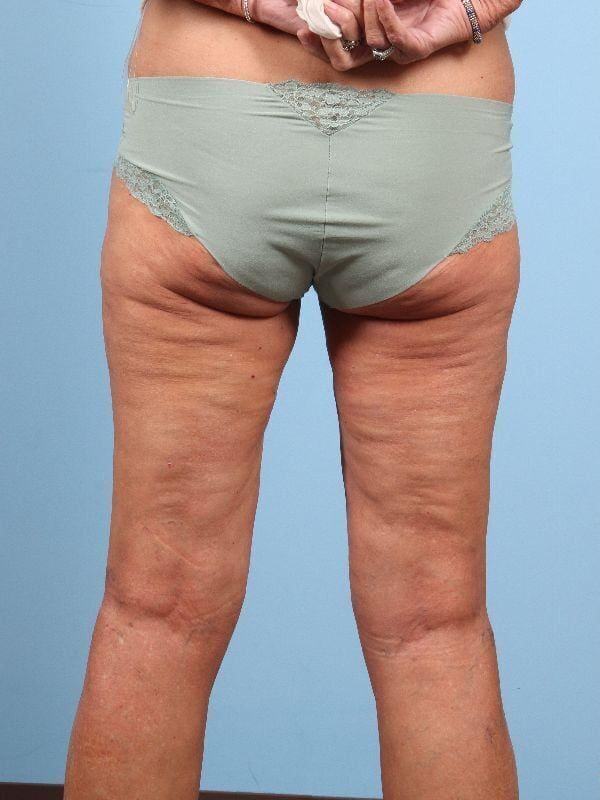 Thigh Lift Patient Photo - Case 16746 - before view-6