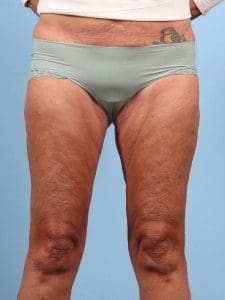 Thigh Lift - Case 16746 - Before