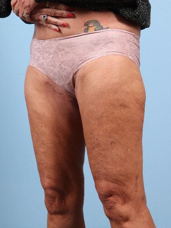 Thigh Lift Patient Photo - Case 16746 - after view-3