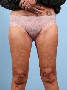 Thigh Lift - Case 16746 - After