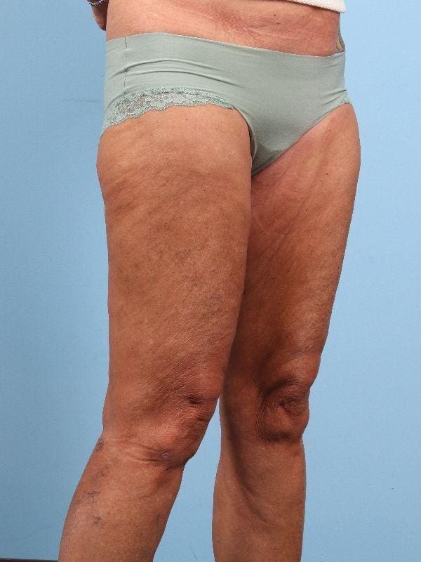 Thigh Lift Patient Photo - Case 16746 - before view-4