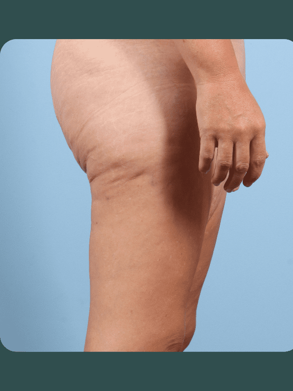 Thigh Lift Patient Photo - Case 16763 - before view-2