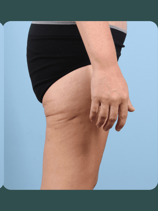 Thigh Lift Patient Photo - Case 16763 - after view-2