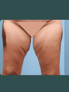 Thigh Lift - Case 16763 - Before