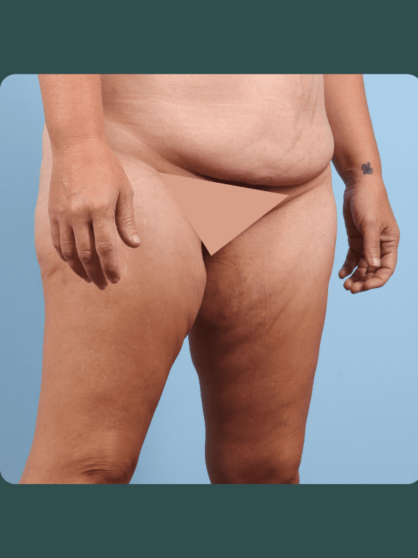 Thigh Lift Patient Photo - Case 16763 - before view-4