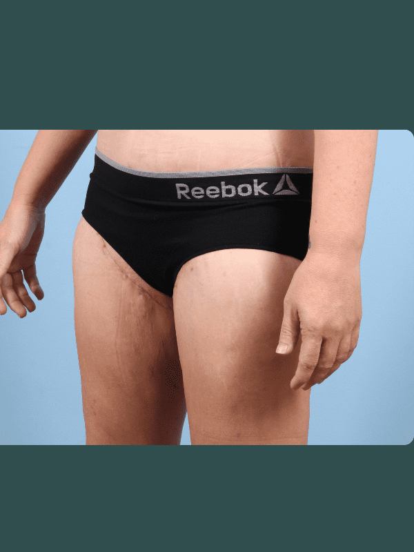 Thigh Lift Patient Photo - Case 16763 - after view-3